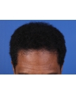 After Hair Transplant&nbsp;Front